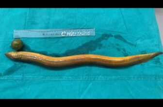 Man Sticks 2-Foot Eel up His Butt, Will get Surgical procedure After Eel Chews Via His Intestines